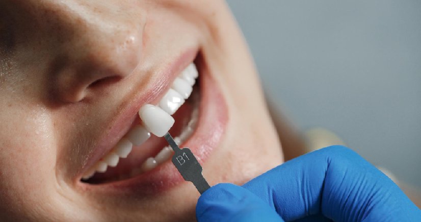 Cosmetic Dentistry Bangalore
